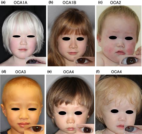 Ocular Albinism Symptoms Types Genetics And Treatment