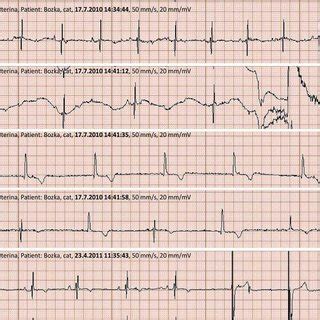 Figure1. Resting ECG immediately before carotid sinus massage, sternal... | Download Scientific ...