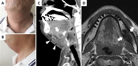 Ludwig’s Angina and Mandibular Osteomyelitis after Dental Extraction | JMA Journal