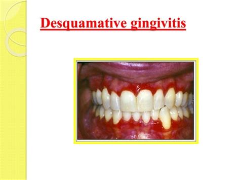 Desquamative Gingivitis Diagnosis and Management