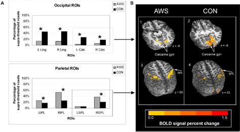 Figure 3 from Functional MRI of a child with Alice in Wonderland syndrome during an episode of ...