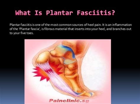 Plantar fasciitis - causes, symptoms and treatments