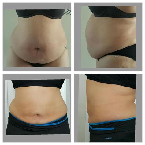 Affordable Lipolysis Injections in South Africa