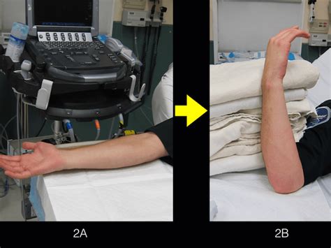 Trick of the Trade: Patient positioning for ultrasound-guided ulnar nerve block