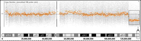 Deletion in 11q25 shown in Affymetrix human SNP array 6.0. Affymetrix ...