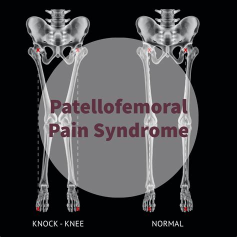 Patellofemoral Pain Syndrome (PFPS) – Family Health Options