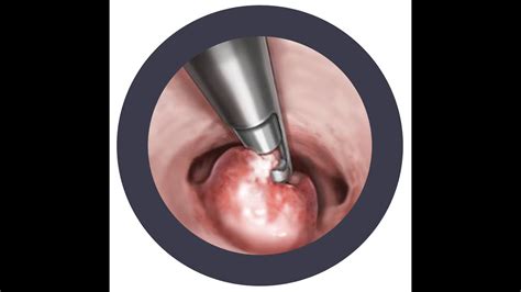 Hysteroscopy Polypectomy