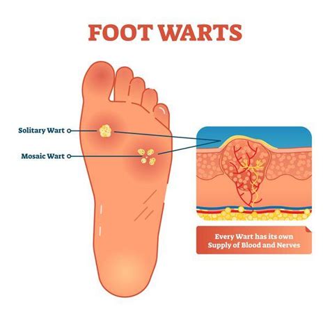 Plantar Wart Root Diagram | Bruin Blog