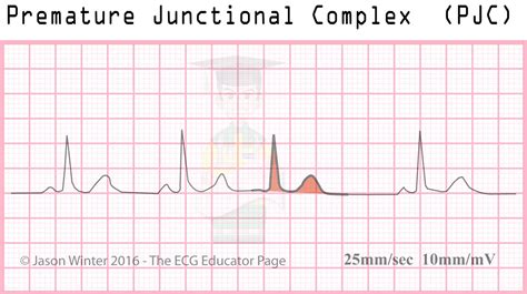 ECG Educator Blog : Junctional Rhythms