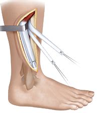 Tendon Transfer Procedure in Broward & Palm Beach | Florida Foot & Ankle