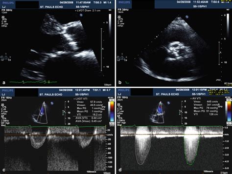 Echocardiographic Evaluation of Aortic Stenosis | Radiology Key