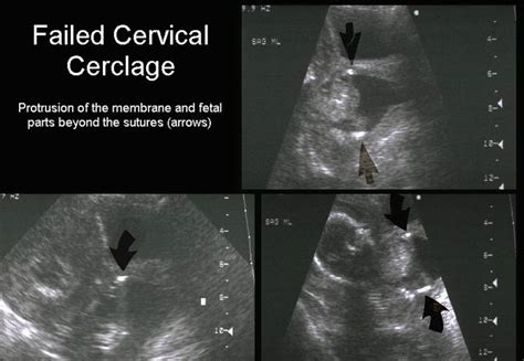 Cervical Cerclage