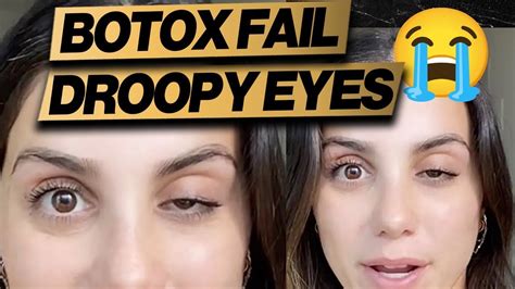 Botox Gone Wrong: Droopy Eye + Cheap Fix - YouTube