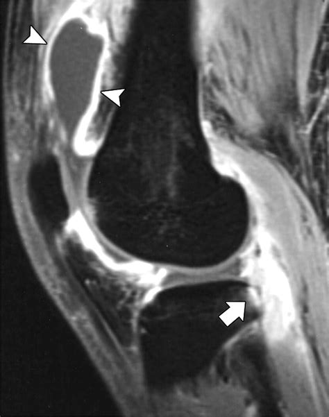 Arthritis In Knee Mri at Harry Johnson blog