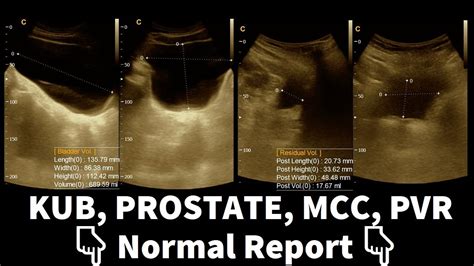 Normal Report | KUB | PROSTATE | MCC | PVR | Ultrasound | Report ...