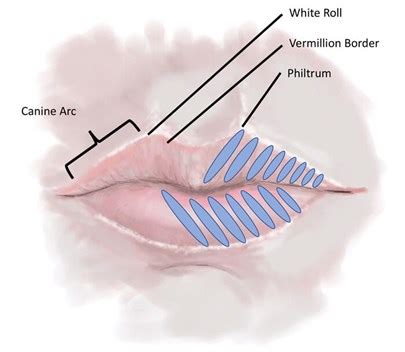 HOW I DO IT - Lip augmentation: lip tenting technique | The PMFA Journal