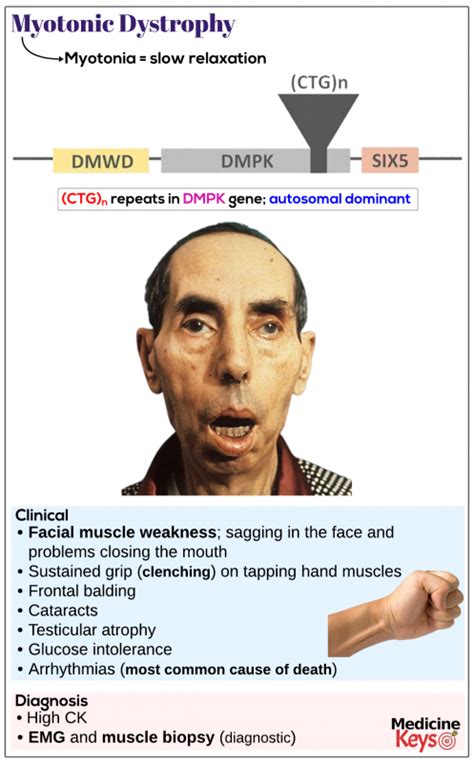 Myotonic dystrophy, type 1 - Medicine Keys for MRCPs