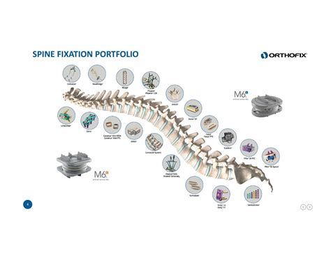 Orthofix (OFIX) To Acquire Spinal Kinetics - Slideshow - Orthofix ...