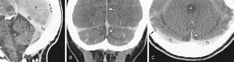 Cranial Meninges | Radiology Key