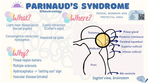 Parinaud's syndrome — Neudrawlogy: Simplifying Neurology