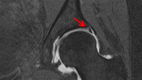 Hip Arthroscopy for Labral Tears - BroadcastMed