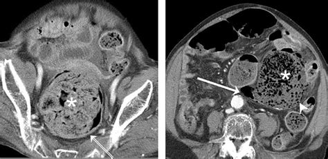 SciELO - Brasil - Differentiation between stercoral perforation and ...