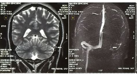 (A) MRI brain, showing lack of flow void of left sigmoid venous sinus ...