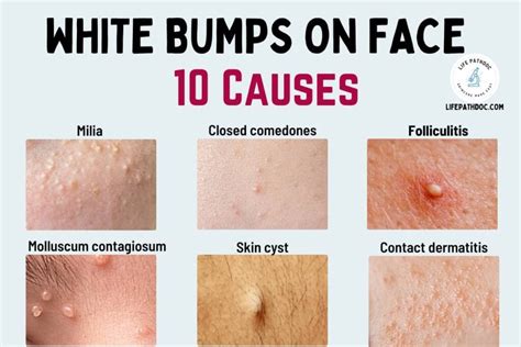 White Bumps on Face: Milia and 9 Other Causes