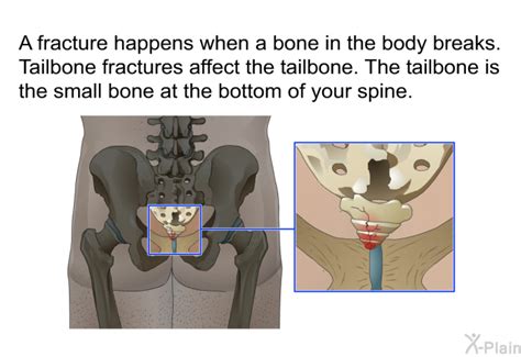 PatEdu.com : Tailbone Fracture