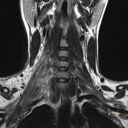 Brachial Plexus Injury Mri