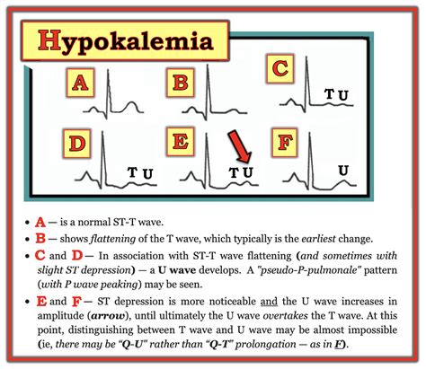 Dr. Smith's ECG Blog: Adding to the many faces of Hypokalemia....