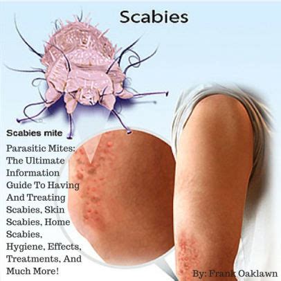 Scabies: Parasitic Mites: The Ultimate Information Guide To Having And ...