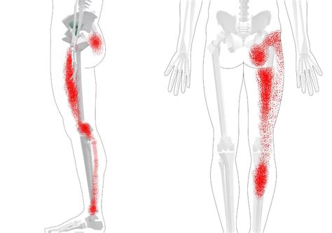 Gluteus Minimus Trigger Points (Overview - Self Treatment Tips)