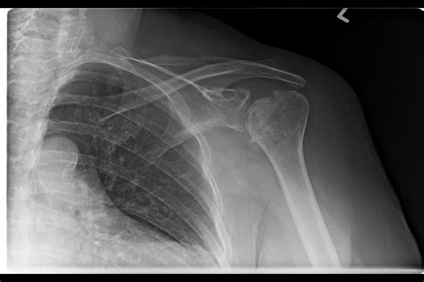 Ortho Dx: Shoulder Pain After Recovery of Humerus Fracture - Clinical Advisor