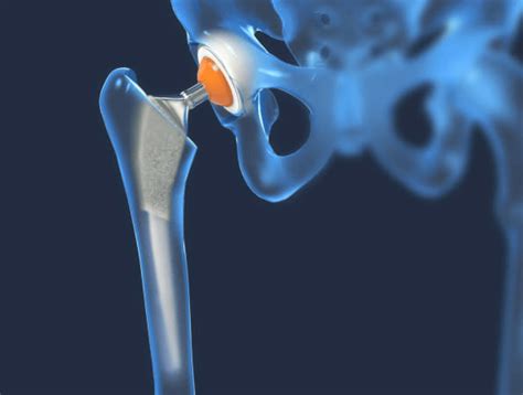 What Is a Hip Replacement? | GlobMed