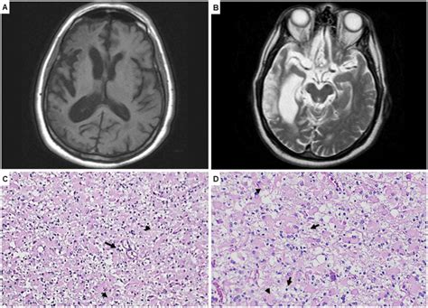 Rasmussen encephalitis: an older adult presentation? - Dementia ...