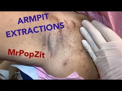 Armpit extractions. Clearing blackheads and ingrown hairs. Multiple ...