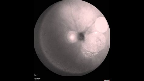 Huge epipapillar floater (suppose to be Weiss ring) just before YAG-laser vitreolysis - YouTube