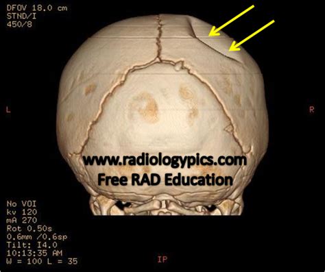 Depressed Skull Fracture in an Infant – Non-accidental Trauma versus ...