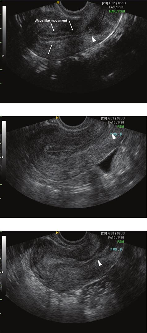 Ultrasound images of endometrium. Echogenisity was decided by the... | Download Scientific Diagram