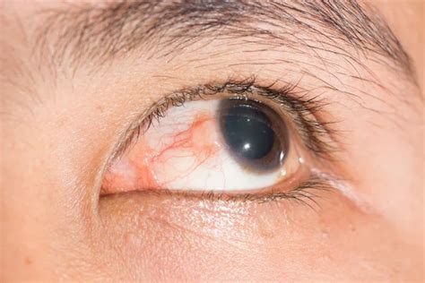 Nodular episcleritis at eye test — Stock Photo © arztsamui #105260550