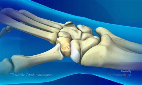 Thumb Arthroplasty | Proliance Orthopedic