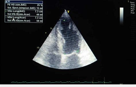 Transthoracic echocardiography showing severe LV systolic dysfunction ...