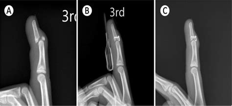 Union of mallet fracture. a The pre-operative radiograph showed mallet... | Download Scientific ...