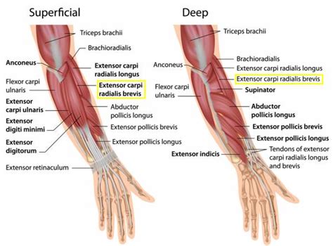 Lateral Epicondylitis - Physiopedia