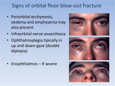 orbital floor fracture complications - Has Major Portal Galleria Di ...