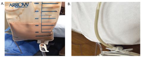 Complete Response to Intra Pleural Instillation of TPA in Four Complicated Patients with ...