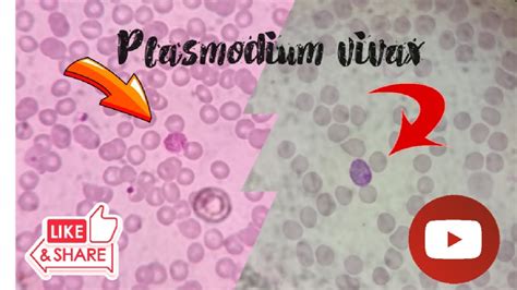 Plasmodium vivax under microscope 100x||malaria Parasite - YouTube