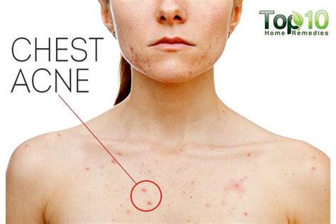 Home Remedies to Get Rid of Chest Acne | Top 10 Home Remedies