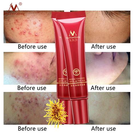 2PCS Skin Care Acne Cleaning Cream Remove Repair Comedone Pimple Acne Quickly Face Acne Cream ...